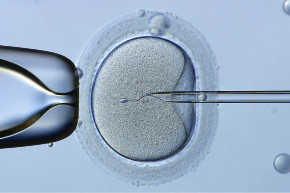 ICSI işleminde tek sperm hücresinin mikropipetle yumurtanın içine enjekte edilmesi